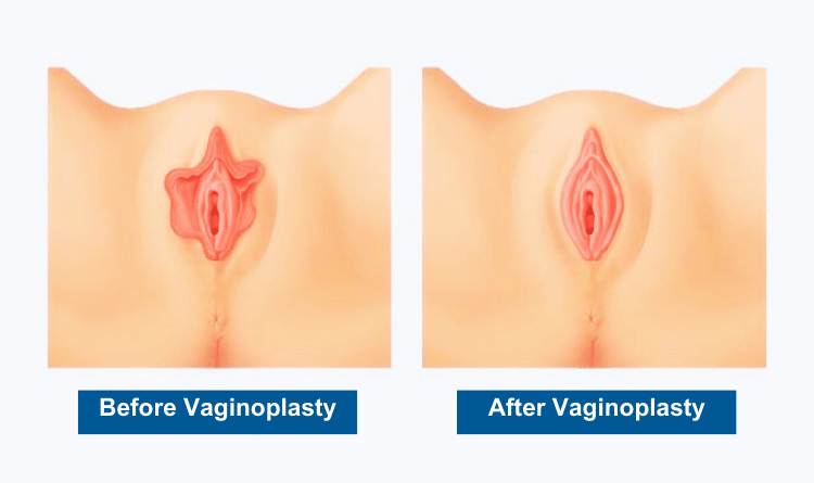 Vaginoplasty Risks & Complications