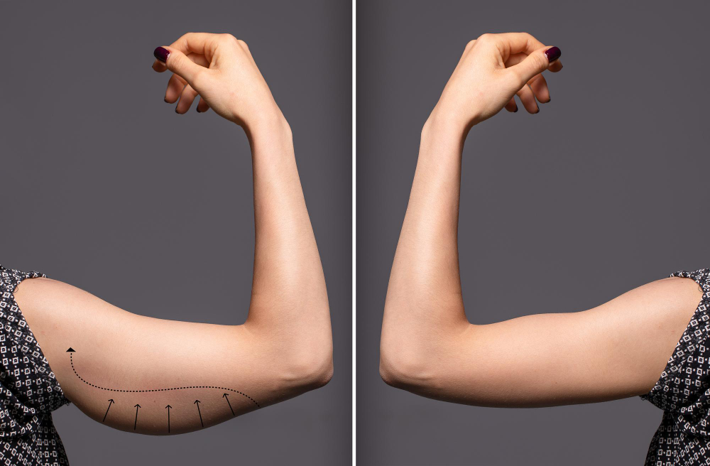 arm skin removal before after photo