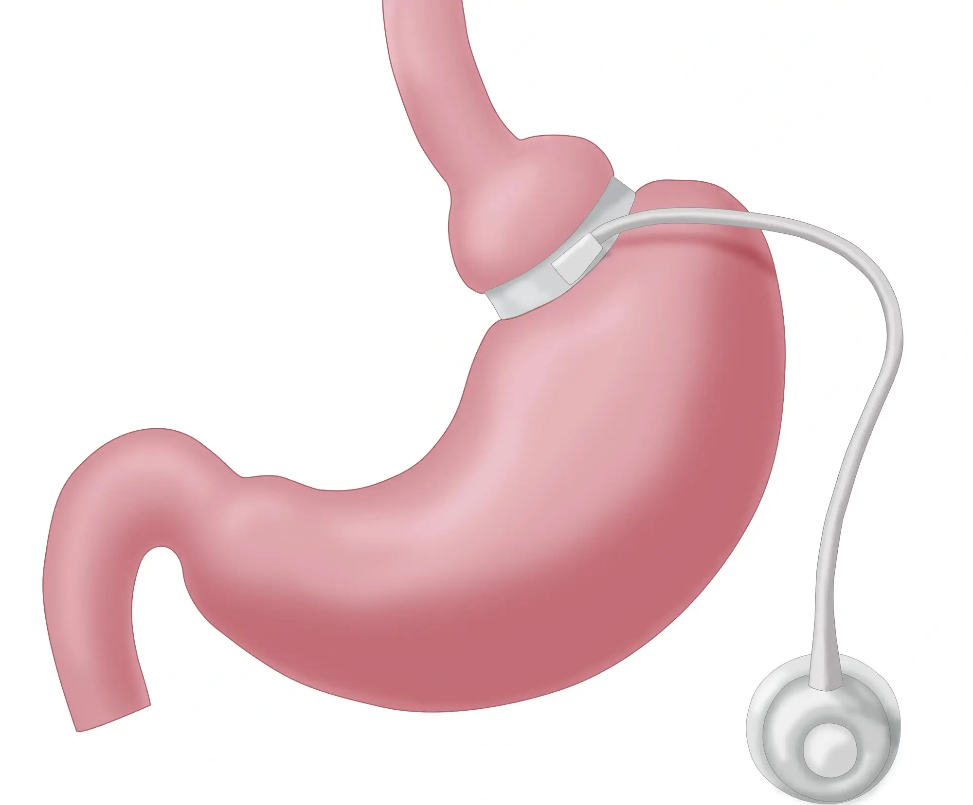 Gastric Band Surgery in Turkey