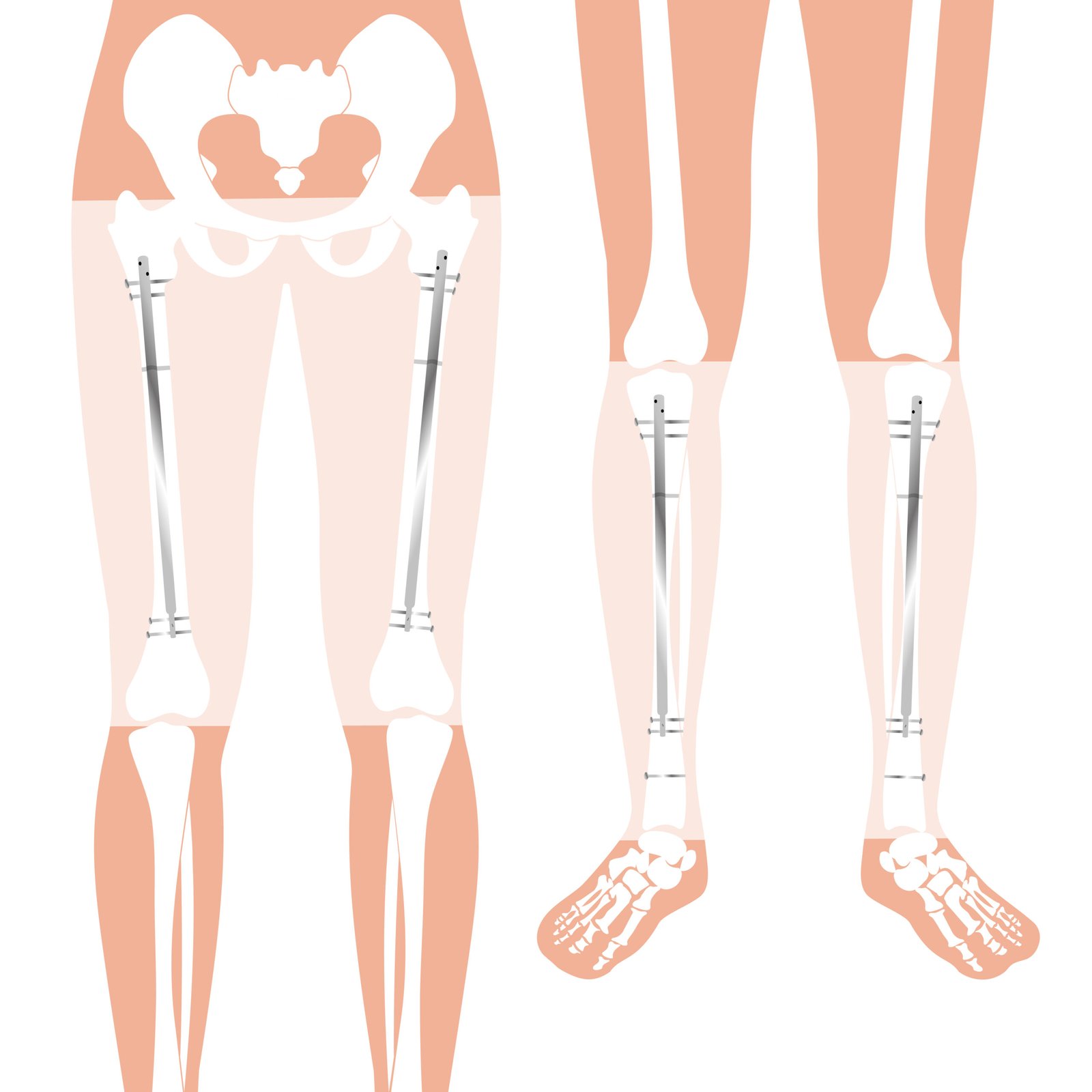 Limb Lengthening Surgery in Turkey