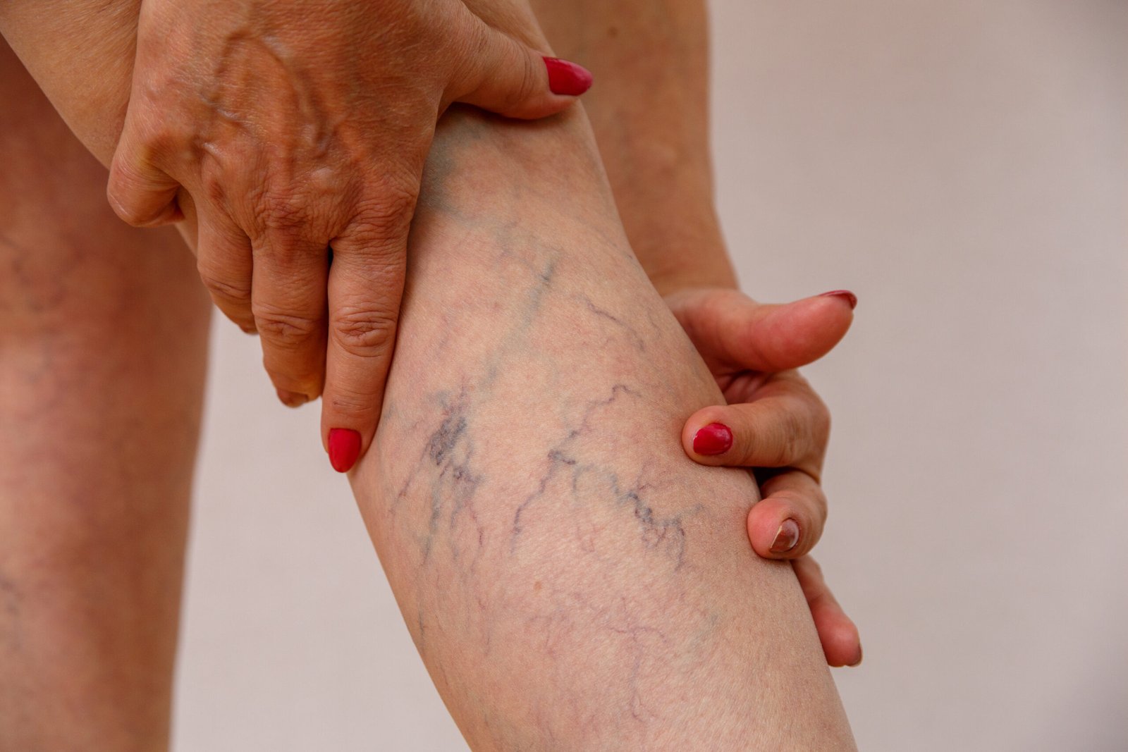 Varicose Veins Treatment