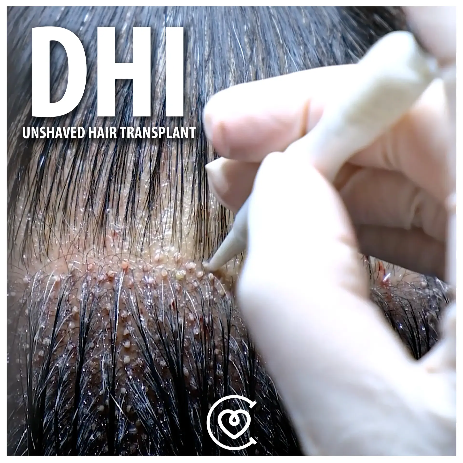 Hair Transplant for Women 2 Cayra 2 UNSHAVED HAIR TRANSPLANT