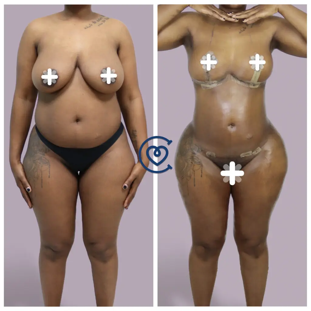 Mommy Makeover in Turkey, Packages and Costs 2025 7 Liposuction in Turkey