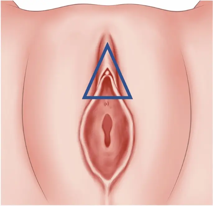Genital Aesthetics 6 Clitoral Hood Reduction Treatment