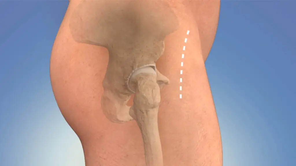 Hip Replacement Surgery