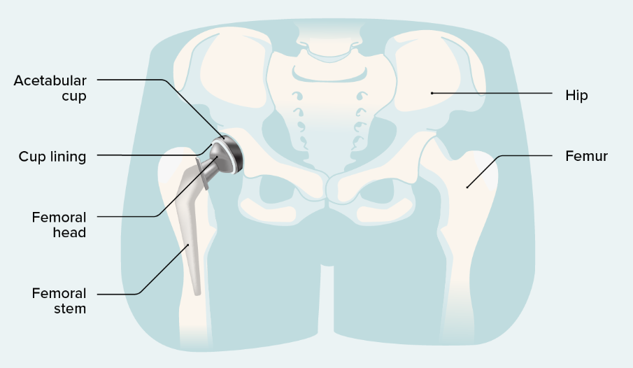 Hip Replacement Surgery Procedure