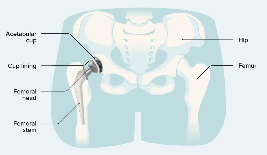 Hip Replacement Surgery Procedure