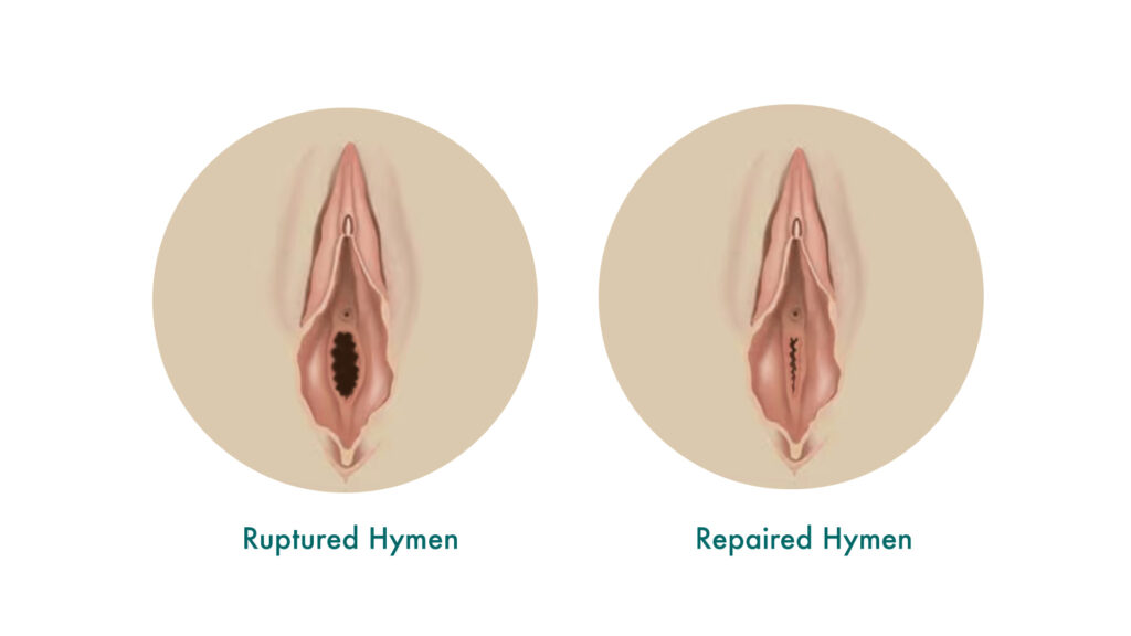 Hymenoplasty Treatment