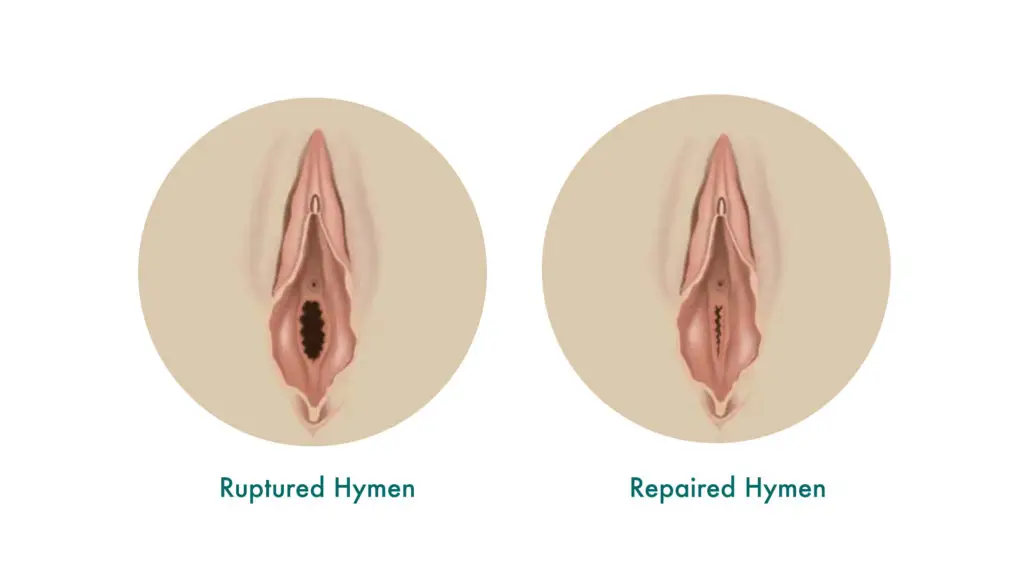 Genital Aesthetics 7 Hymenoplasty Treatment