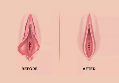 Labia Majora Augmentation Treatment