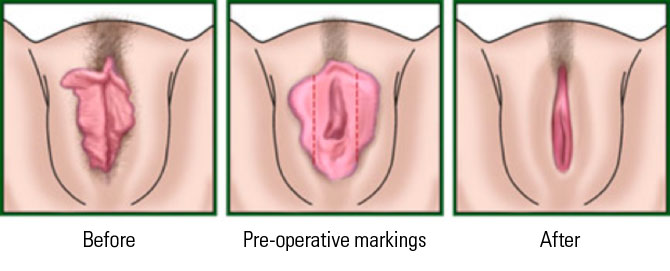 Labiaplasty Treatment