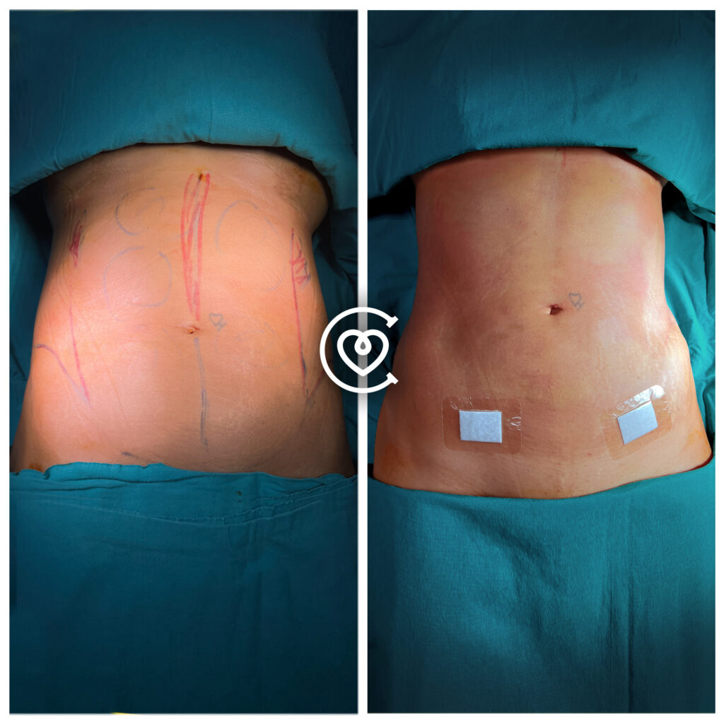 best liposuction before and after