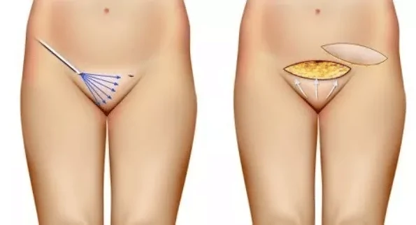 Mons Pubis Aesthetic Treatment