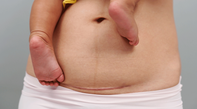 Postpartum Scar Treatment