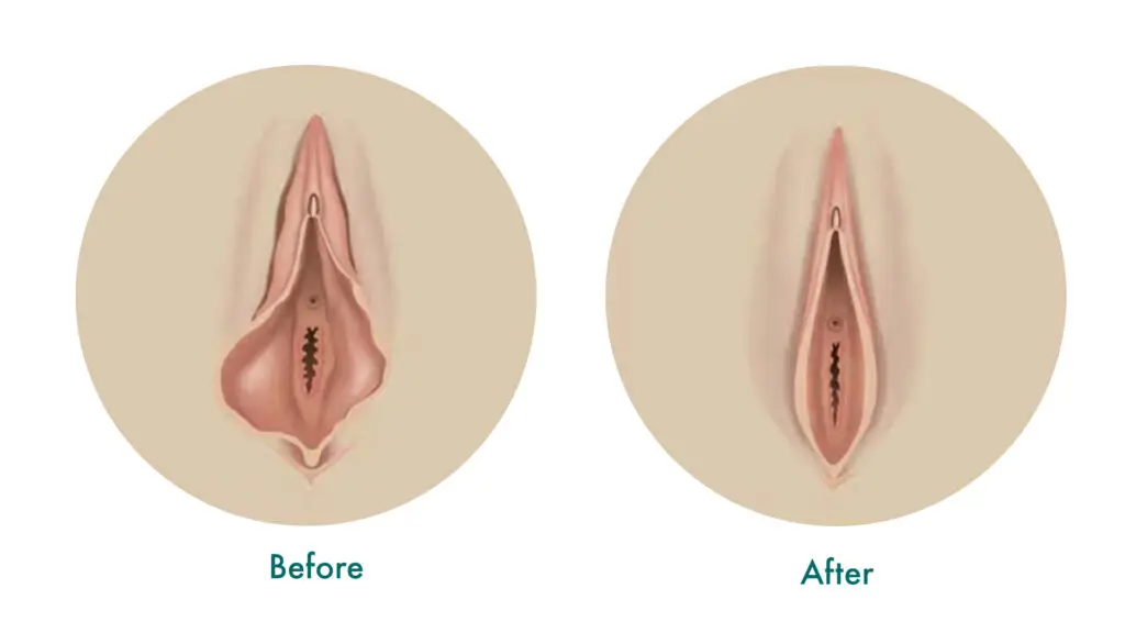Genital Aesthetics 3 Vaginoplasty Treatment