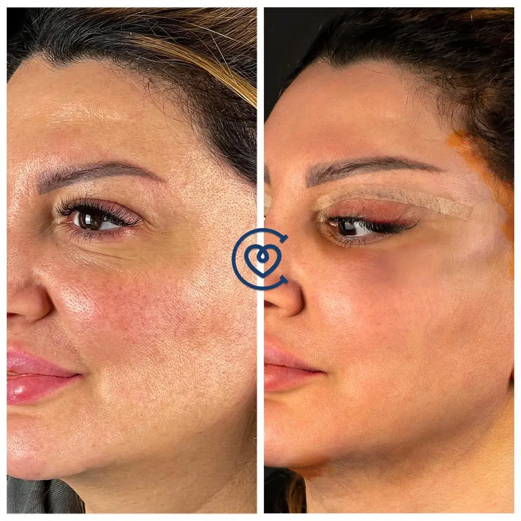 Cat Eye Surgery – Almond-eye surgery: STEP-BY-STEP GUIDE 1 WhatsApp Image 2023 09 29 at 10.11.01