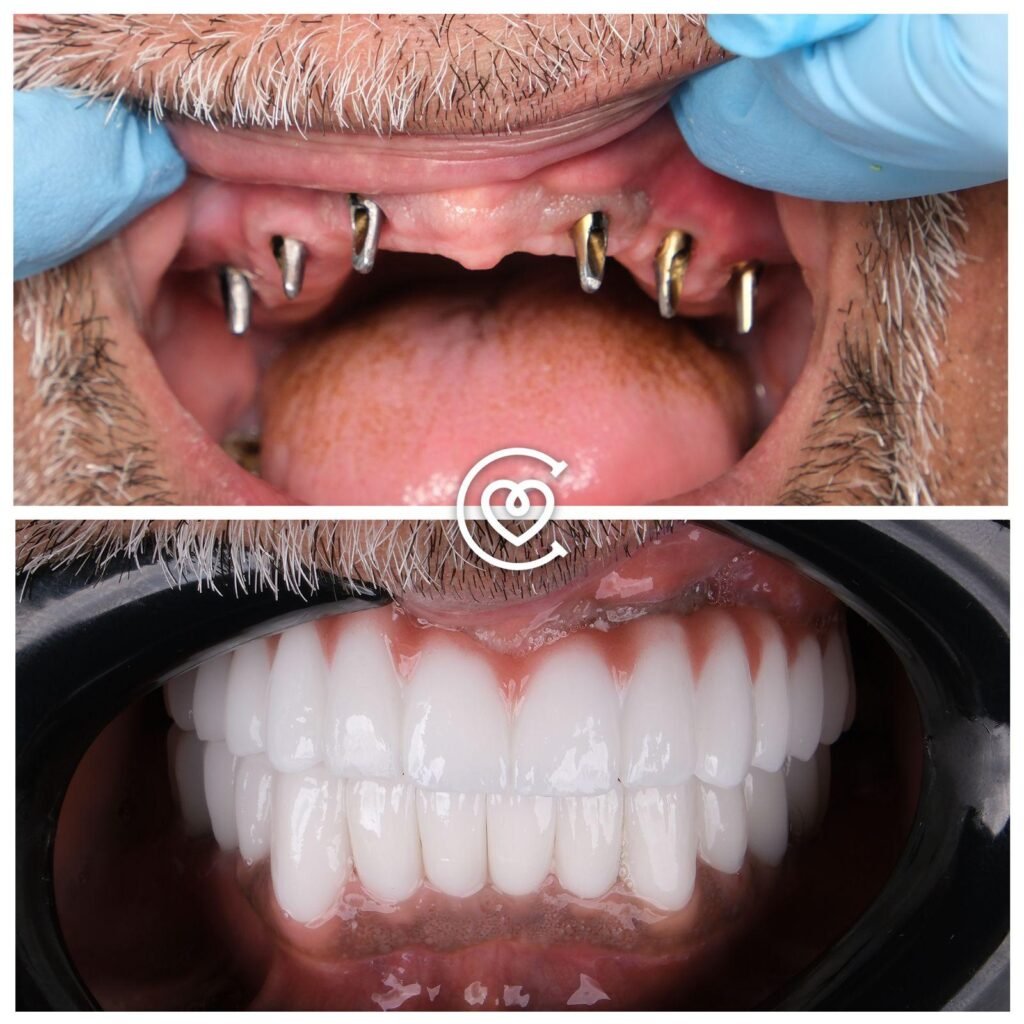 All-on-6 Dental Implants
