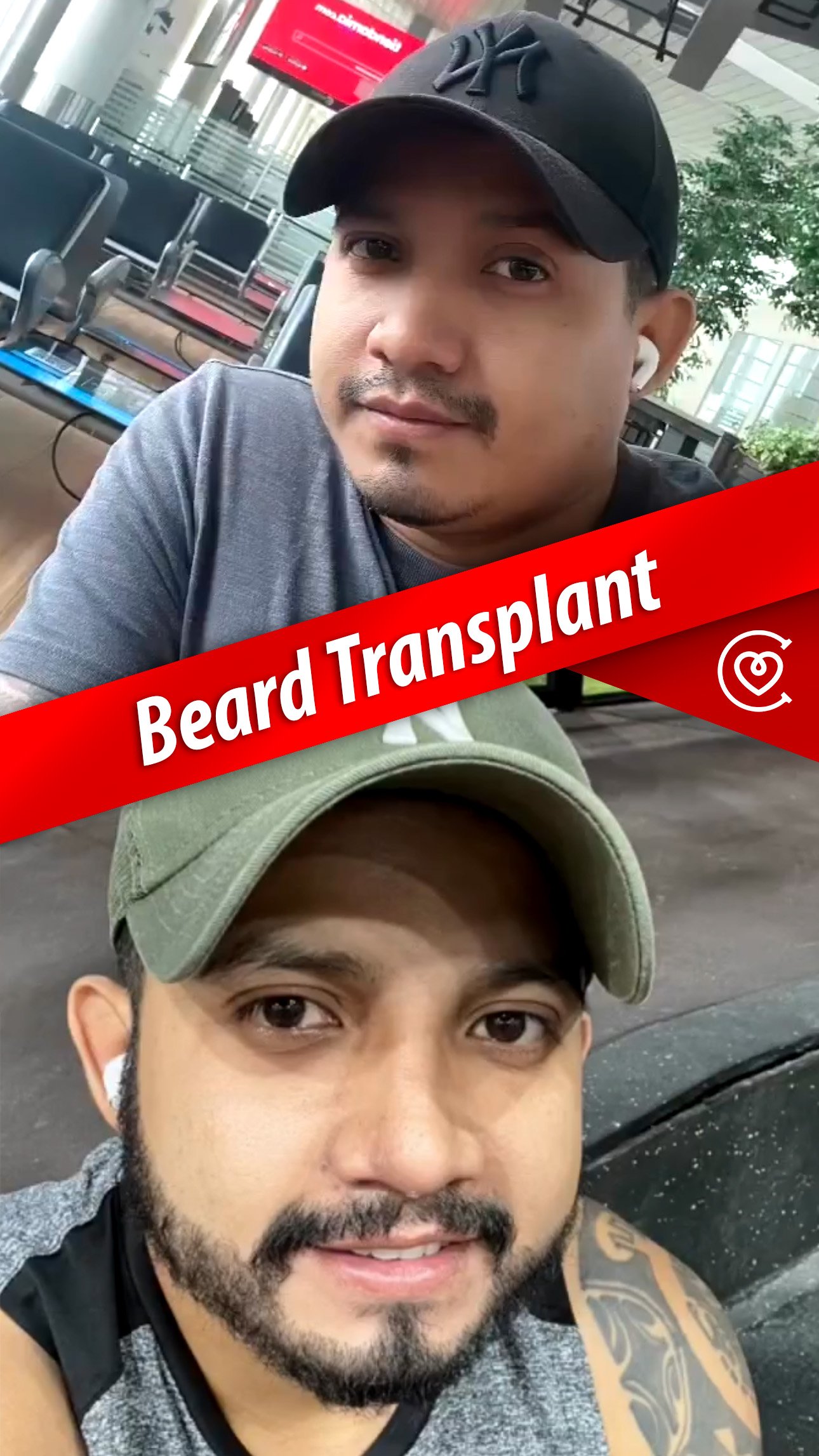 Beard transplant Before and after