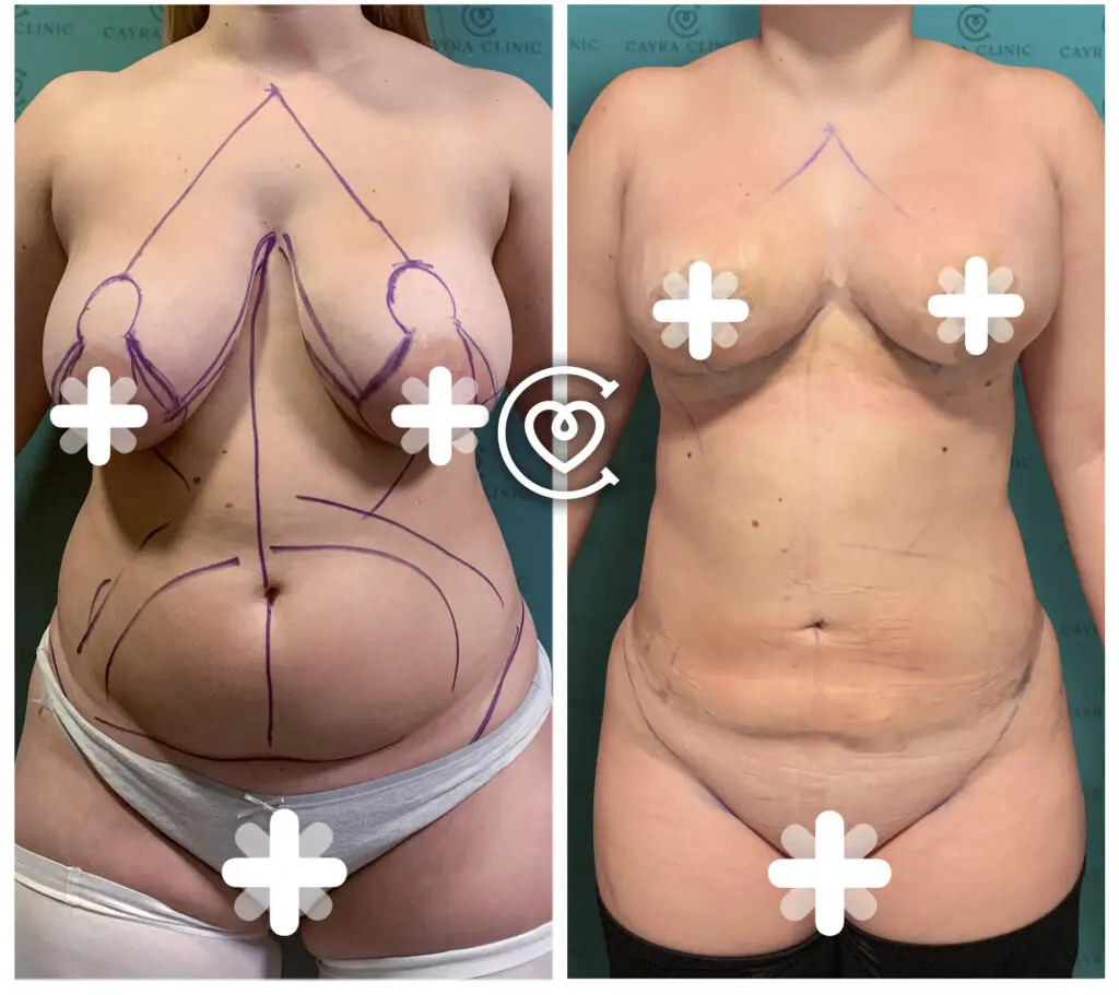 Mommy Makeover in Turkey, Packages and Costs 2025 8 Aesthetic Surgery Turkey