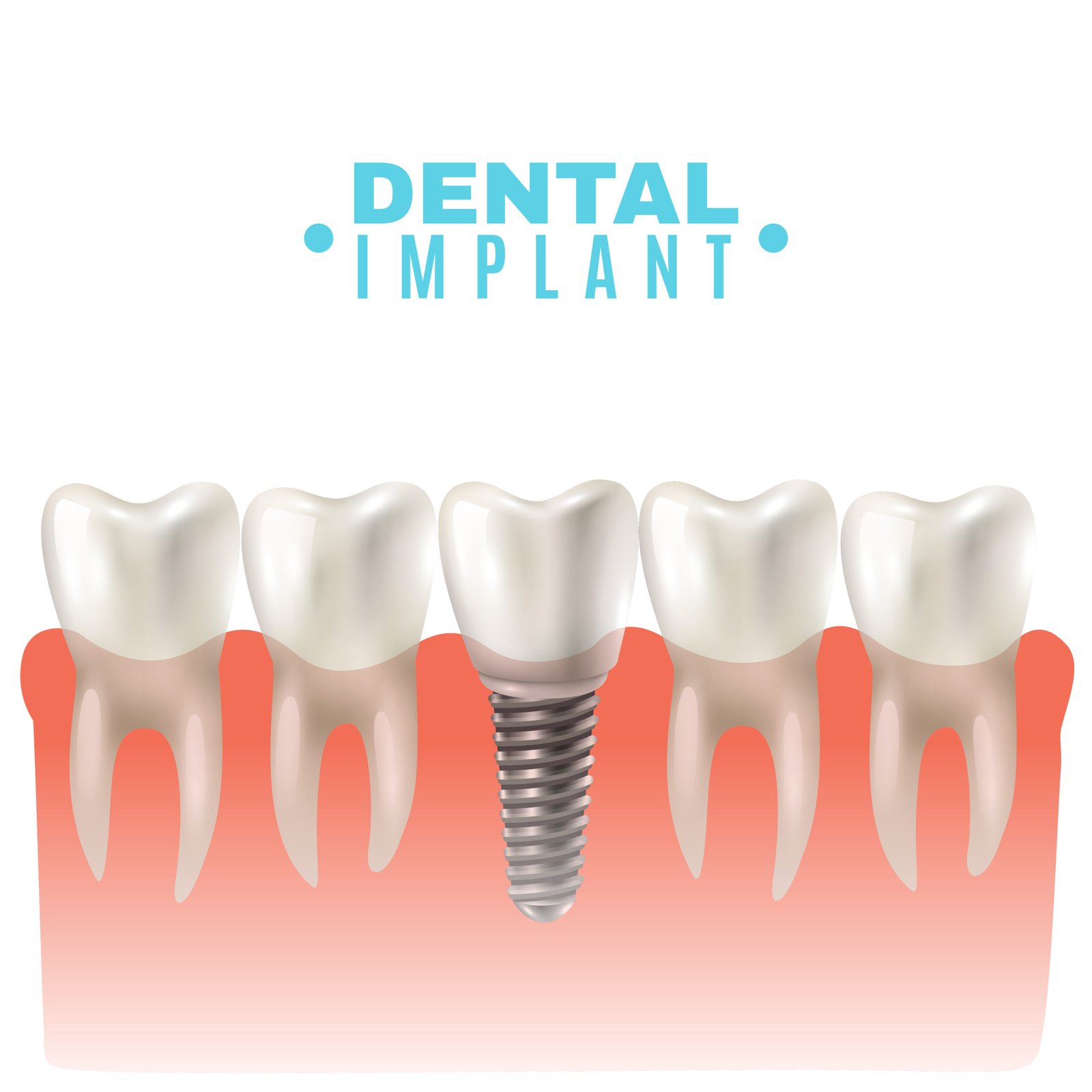 Zygomatic Dental implants