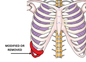 Rib Removal Surgery Showing ribs which will be modified or removed