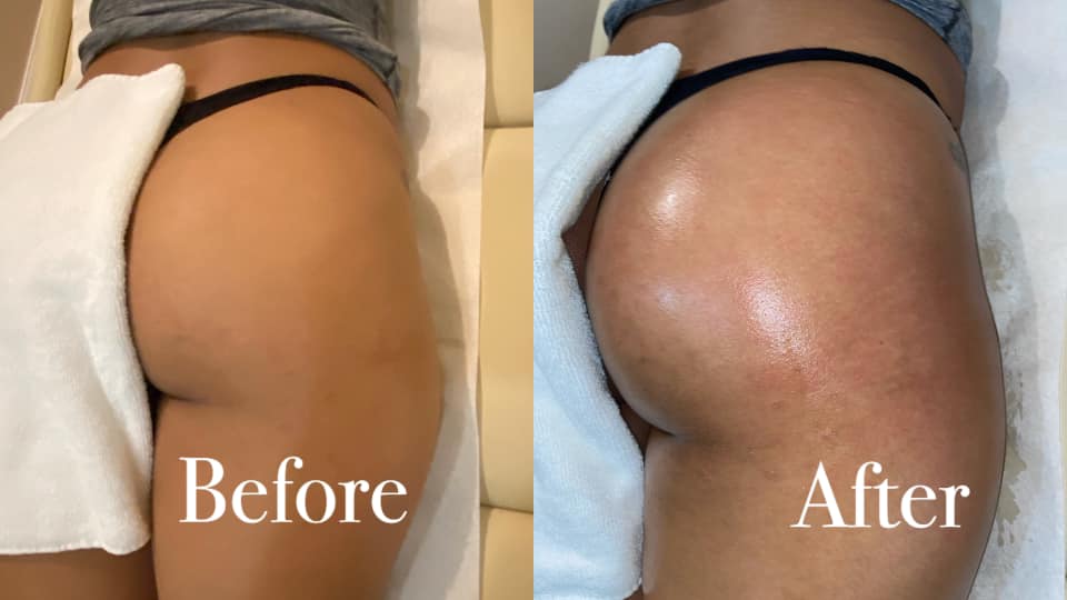 lymphatic drainage massage before and after