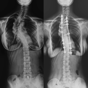 Scoliosis Treatment in Turkey 1 scoliosis surgery