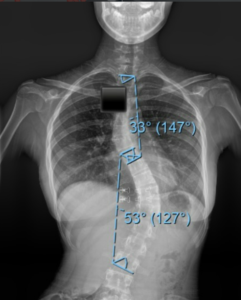scoliosis surgery