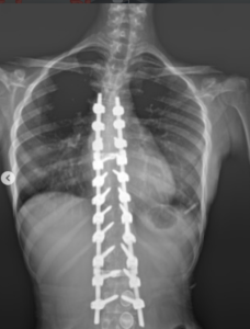 Scoliosis Treatment in Turkey 4 Ekran goruntusu 2026 06 24 182917