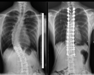 Scoliosis Treatment in Turkey 2 Scoliosis Surgery for a 14-Year-Old Child
