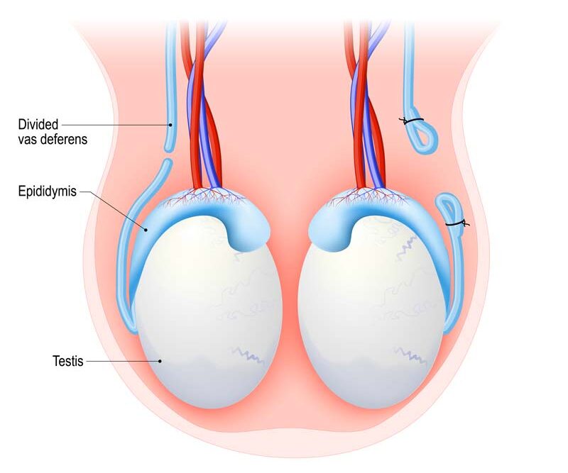 Vasectomy Treatment