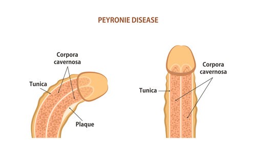 Peyronie’s Disease