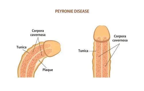Peyronie's Disease in Turkey: Find Relief and Restore Confidence 1 Peyronie’s Disease