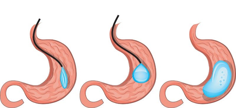 12 Month Gastric Balloon in Turkey