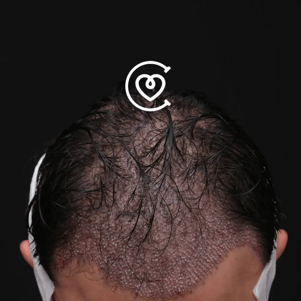 No Shave Hair Transplant 246 No shave hair transplant