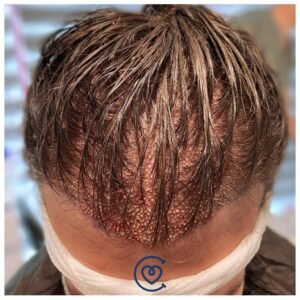 No Hair Cut Hair Transplant before and after photo