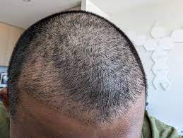 Avoid a Failed Hair Transplant | Clinic Choice 2 Failed Hair Transplant