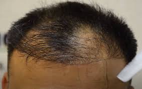 Avoid a Failed Hair Transplant | Clinic Choice 1 Hair Transplant Failure