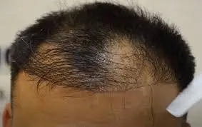 Hair Transplant Failure