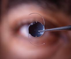 Lens Replacement Surgery