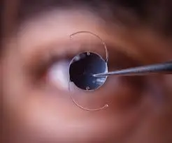 Lens Replacement Surgery