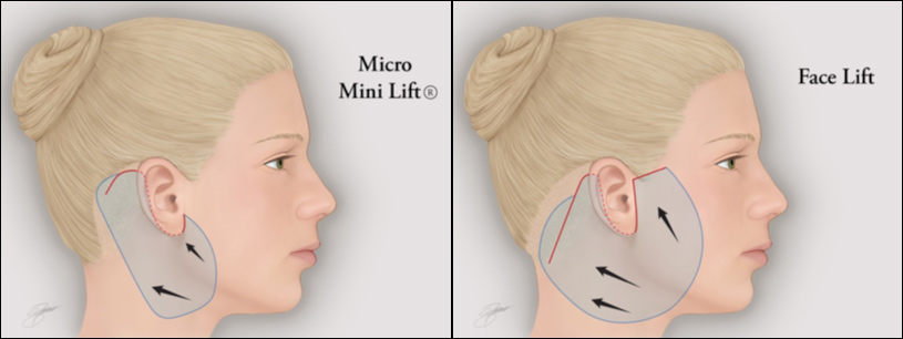 Mini Face Lift Surgery