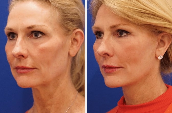 Mini Face Lift Surgery Before And After