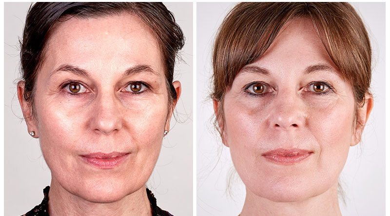 Non-Surgical Face Lift