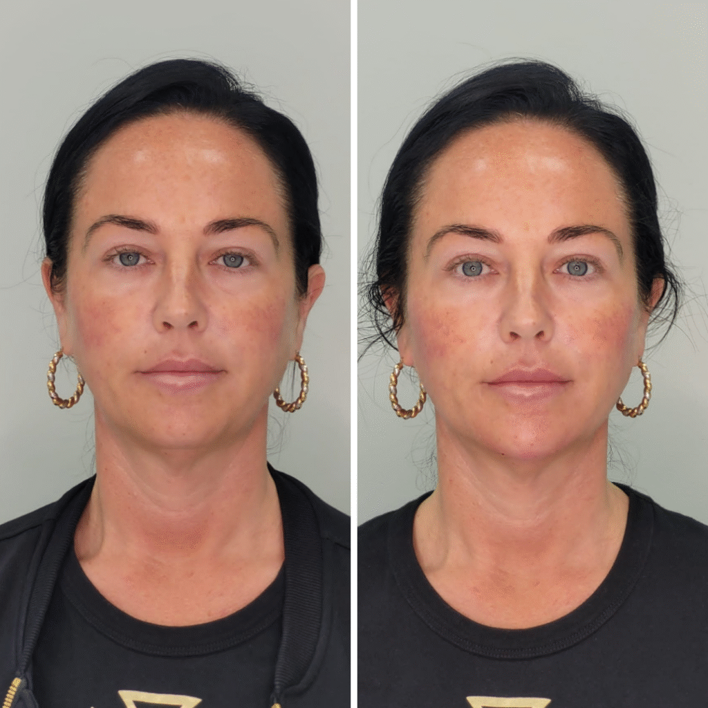 Non-Surgical Face-Lift