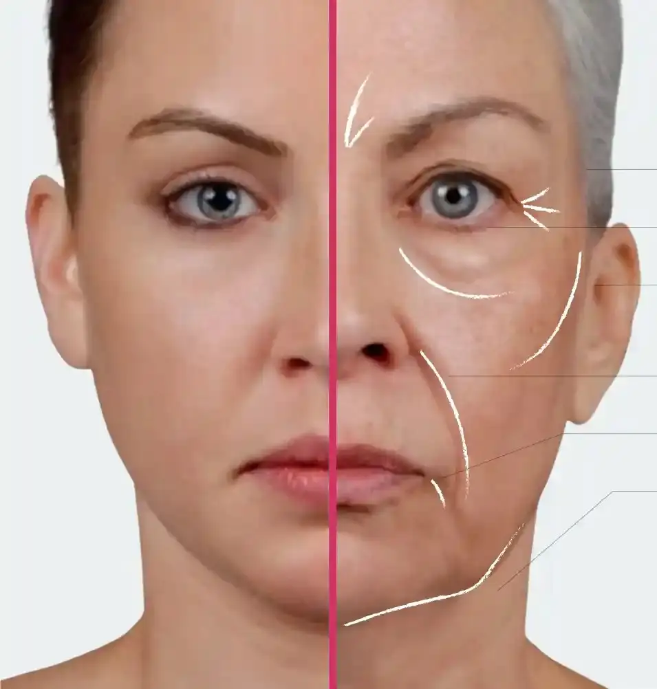 Non-surgical Facelift in Turkey 1 Non-Surgical Face Lift Surgery