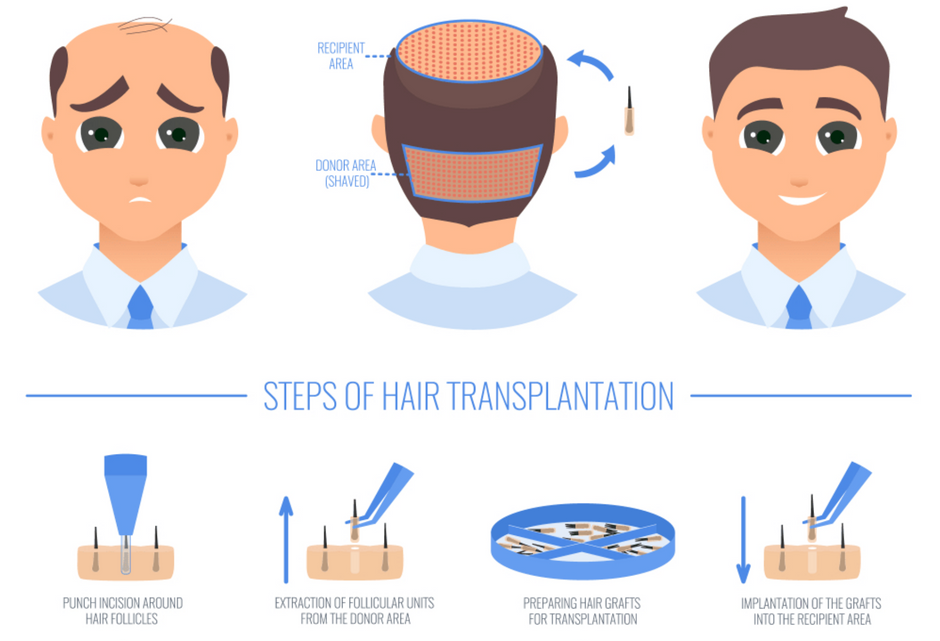Procedure of Robotic Hair Transplant