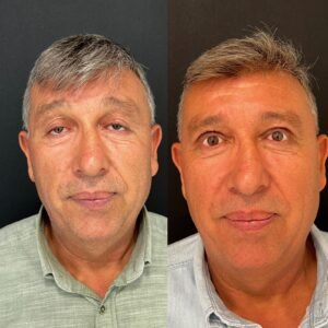Ptosis Treatment- Before and After