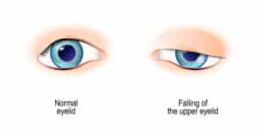 What is Ptosis