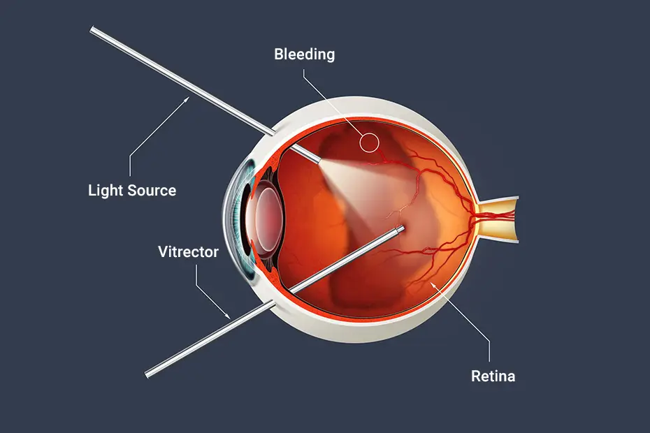 The Vitrectomy Procedure